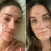 Mulher acusa esteticista de celebridades de causar queimaduras no rosto após peeling químico