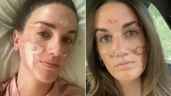 Mulher acusa esteticista de celebridades de causar queimaduras no rosto após peeling químico