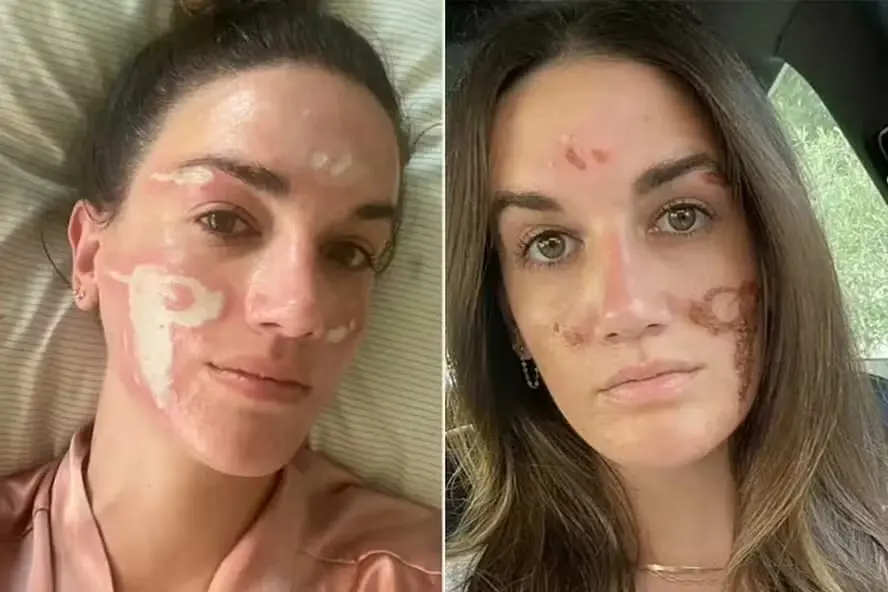 Mulher acusa esteticista de celebridades de causar queimaduras no rosto após peeling químico