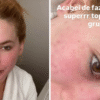 Virgínia Fonseca nega cirurgia plástica e explica procedimento a laser para tratar cicatrizes de acne