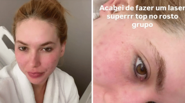 Virgínia Fonseca nega cirurgia plástica e explica procedimento a laser para tratar cicatrizes de acne