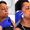 Samantha Schmütz passa por transformação com médico das Kardashians e vídeo viraliza nas redes