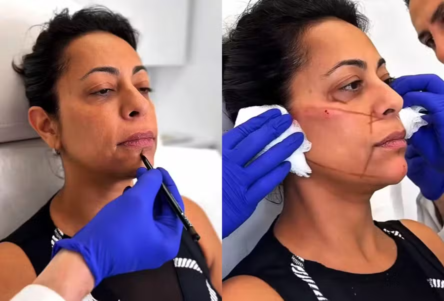 Samantha Schmütz passa por transformação com médico das Kardashians e vídeo viraliza nas redes