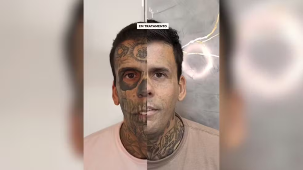 “Mais tatuado do Brasil” passa por 6ª sessão de remoção; veja o antes e depois