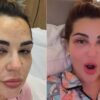 Deolane surge com hematomas no rosto e assusta web