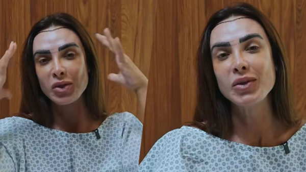 Nicole Bahls realiza transplante capilar após alopecia e comemora 2 capa 34