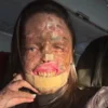 karine felipe cancer de pele