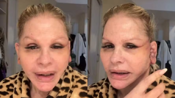 Monique Evans atualiza recuperação após cirurgia facial e diz que banco não reconheceu seu rosto 2 Monique Evans